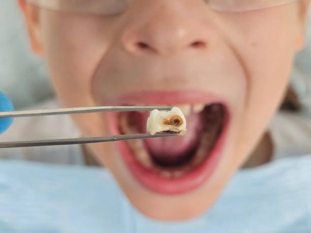Best Urgent Care for Lost Fillings or Crowns in Berlin, WI