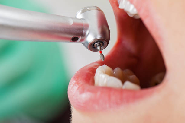 Best Emergency Dental Care for Broken or Chipped Teeth in Berlin, WI